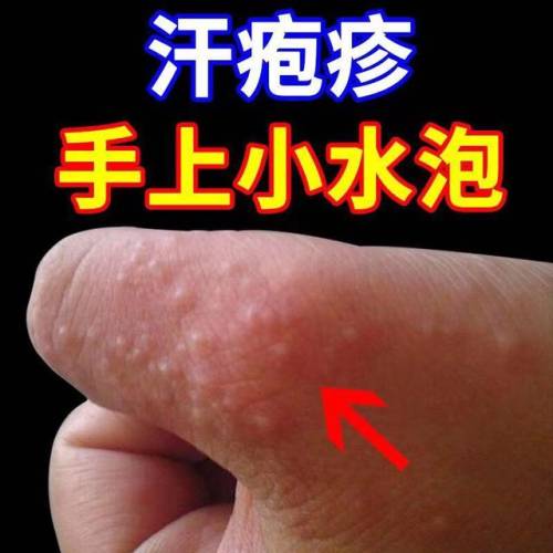 脚底长了像水泡一样的东西很痒是怎么回事(脚上长一堆小痘痘很痒)插图